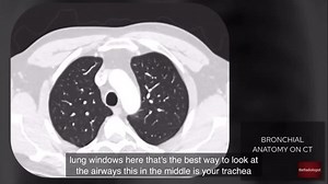 Knowing the anatomy of the airways is vital for being able to accurately read a chest CT. Check out this video which is part of a longer video I just posted on my YouTube account - go to @theradiologistpage and click the link in bio for the full video⁣ ⁣ This is the first in a series of videos on reading basic CT, make sure you subscribe to the YouTube account to be notified when the next video is released⁣ ⁣ SEGMENTAL ANATOMY OF EACH LUNG LOBE:⁣ ⁣ RIGHT UPPER LOBE⁣ Anterior⁣ Posterior⁣ Apical⁣ 