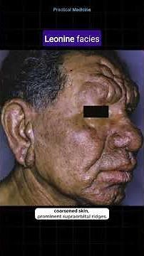 [Picture test 22] What is this facies called and what are the related causes? #OSCEs #leonine