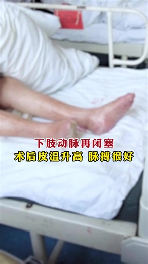 下肢动脉再闭塞，术后皮温升高 脉搏很好 #下肢血管堵塞 #下肢血管闭塞 #下肢血管介入 #下肢通血管 #血管专家袁链