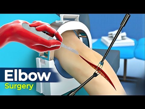 Elbow Joint Replacement (Surgery) 3D Animation | The Scopic Vision