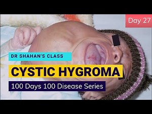 Cystic Hygroma | Dr Shahan's Class ☺️ | 100 Days 100 Disease Series