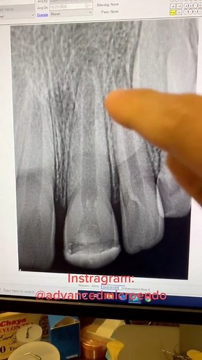 8.2K views · 61 reactions | #dentistry #dentalschool #hygienists #dentists #rootcanaltherapy | Advanced Micro-Endodontics | Facebook