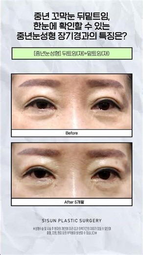 중년 꼬막눈 뒤밑트임, 한눈에 확인할 수 있는 중년눈성형 장기경과의 특징은? #시선성형외과 #shorts