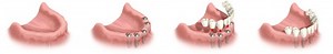 Full Mouth Dental Implants