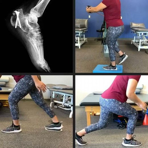 Calcaneal Fracture Exercises (Real Patient
