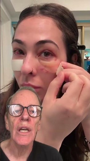 Step By Step Recovery from Eyelid Surgery