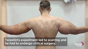 ‘Popeye’ has 3 pounds of dead muscle removed after botched bodybuilding injections