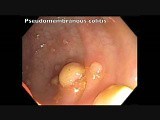 Colonoscopy Channel - Pseudomembranous Colitis • Video • MEDtube.net