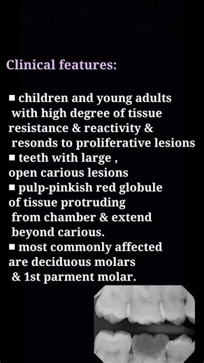 pulp polyp #pulp #shorts #dentist #dental #pulpitis #science #teeth # chronic hyperplastic pulpitis