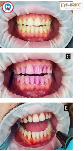 Does Teeth Scaling Damage Your Teeth? || Eledent Dental Hospitals #dentalscaling