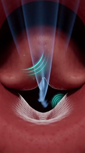 Snoring – What Happens Inside Your Airway While You Sleep? #shortvideo