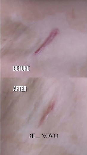 “Watch me burn my keloid off” 😭🔥 Not exactly... but it definitely looks satisfying. #KeloidTreatment
