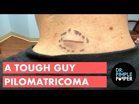 A Tough Guy Pilomatricoma