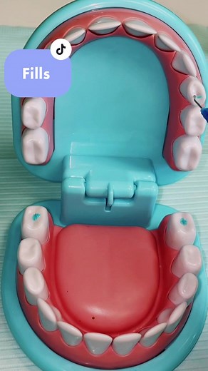 Small Cavity Fillings without Numbing! | Dental ASMR