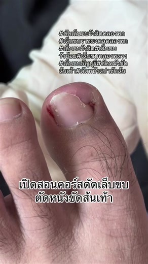 สอนการตัดเล็บขบและหนังขัดส้นเท้า