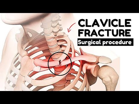 Clavicle Bone Fracture | Surgical procedure, Animation Video