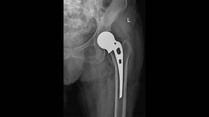 X-ray Image Demonstrating Reconstruction Hip Joint Stock Footage Video (100% Royalty-free) 3392480085 | Shutterstock