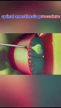 3D Spinal Anesthesia: Needle Path & CSF Flow Visualized”#spinalanesthesia #spinalblock #spinal3d