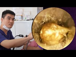 Lấy ráy tai bị bít kín ở cháu bé 耳かき - ASMR耳掃除 | BS: LẠI MINH TUẤN