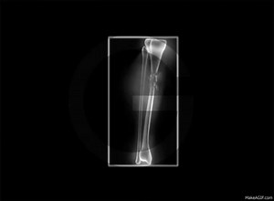 broken bone healed with scaffold on Make a GIF