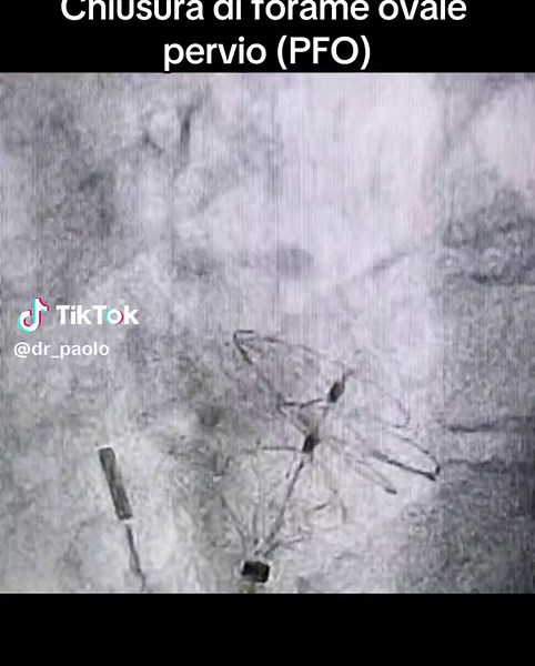 Chiusura di Forame Ovale Pervio: Guida Completa