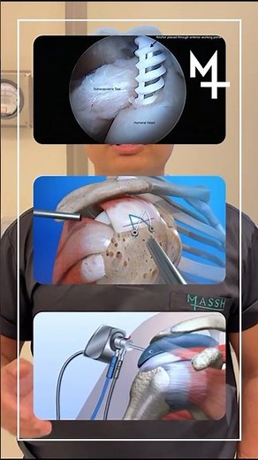 Biceps Tendon Injury & Surgical Repair Explained | MASSH Hospital