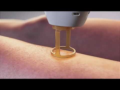 Gentle Pro Series - Laser Hair Removal - Candela GentleMax Pro