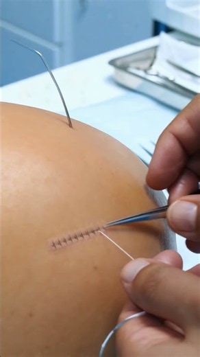 SURGICAL SUTURE IA