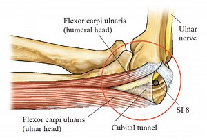 Ulnar Nerve Entrapment at the Elbow