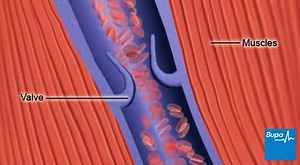 How deep vein thrombosis (DVT) forms- Medical Videos