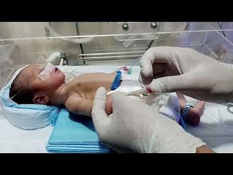 How to Insert an IV Line in a Newborn | Step-by-Step NICU Procedure