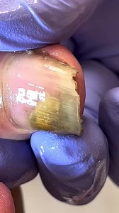 Pedicure for Treating Curled Toenails with Fungus Removal Solutions Z414 #pedicure #toenailremoval #ingrownnail #nail #nails Disclaimer: This video contains clips collected from various sources. Full credit goes to the original Cambodian creators. The video is for educational and monetization purposes. Self-made Flakes are used. All rights belong to their respective owners. | Quranic Life