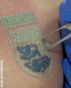 292K views · 260 reactions | Satisfying process of laser tattoo removal Thanks for watching! Please be aware that this video is for entertainment purposes only and techniques shown should not be attempted at home! Partner: clearlasetattooremoval | Crafty Panda | Facebook