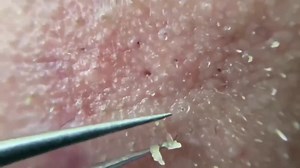Satisfying Pimple Pops and Deep Blackhead Extractions