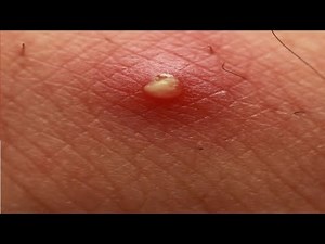 how to get rid of a boil fast