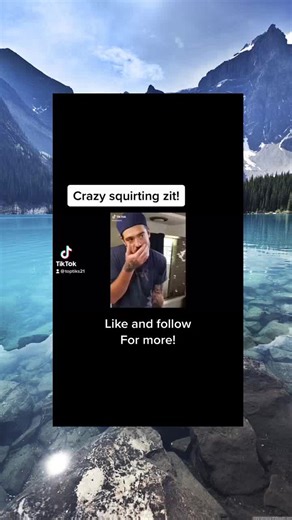 pimple acne cyst popping squeezeyuk explore satisfying video (127)