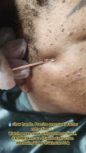 Acne extraction #acneremoval #acne #pimplepopping #comedoneextraction #skintreatment #music