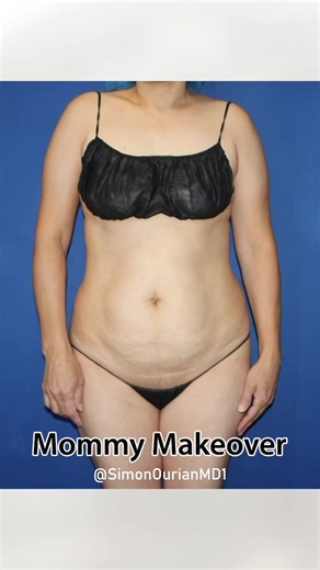 The mommy makeover refines body contour and tightens the skin, helping to achieve a more proportional, slimmer, and toned-looking physique. Using a customized combination of minimal-incision tummy tuck, RFA liposculpture, BBL, breast augmentation, and/or lift, this approach enhances shape and definition with natural-looking results. #MommyMakeover #BodyContouring #TummyTuck #BBL #BreastAugmentation