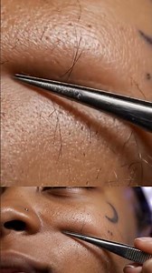 Intense Cheek Purifying Suction with Hair ASMR | Crescent tattoo near cheekbone