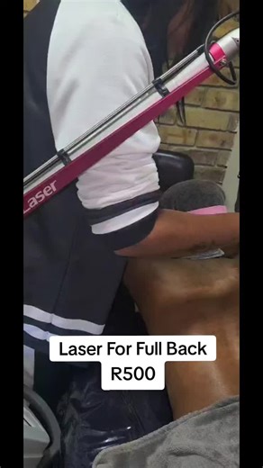 Effective Carbon Laser Back Treatment in Johannesburg