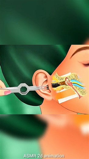 😱😱😱 #earwaxremoval #satisfyingvideo #oddlysatisfying #asmranimation #asmrtreatment #relaxingvideo #viralreels #reelsfb #trendingreels #animationvideo | ASMR 2d animation