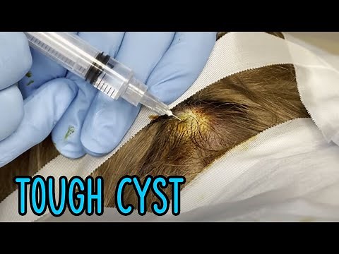 Tough Scalp Cyst