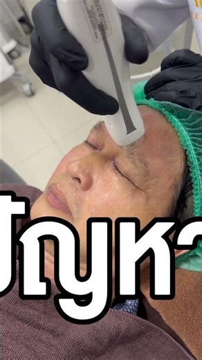 ไม่มีหลุมสิว ￼ สามารถทำโปรแกรม Micronedle RF ได้ไหม ? #หลุมสิว #รักษาหลุมสิว #MicroneedleRF￼
