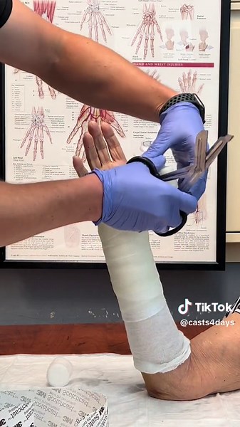 Distal radius fracture with a purple cast to end your day #medical #ASMR #orthopedics