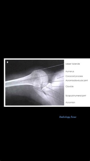 Shoulder joint X Ray with position