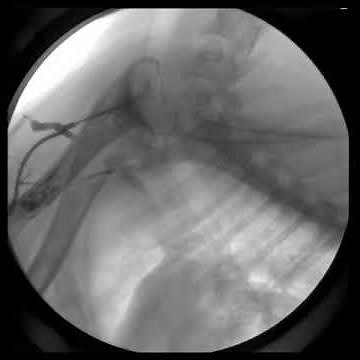 EZ-IO Humeral Head 1