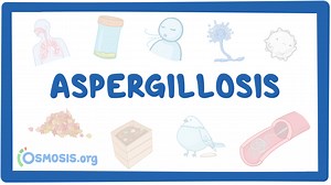 Aspergillosis: Nursing: Video & Causes | Osmosis