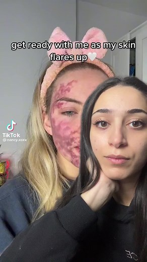 Skin Care Tutorial: Managing Flaring Skin Conditions