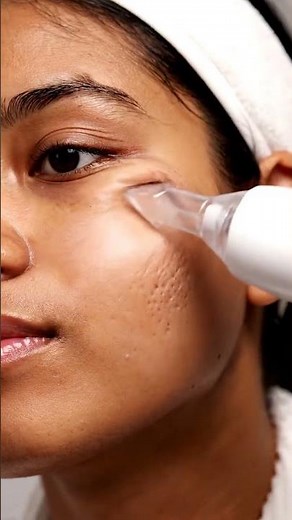 “Extreme Close-Up Blackhead Removal — So Satisfying!”