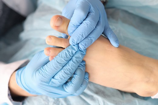 Mycose des pieds (entre les orteils) : comment la soigner ?